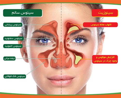 درمان سينوزيت گرفتگي و احتقان بيني